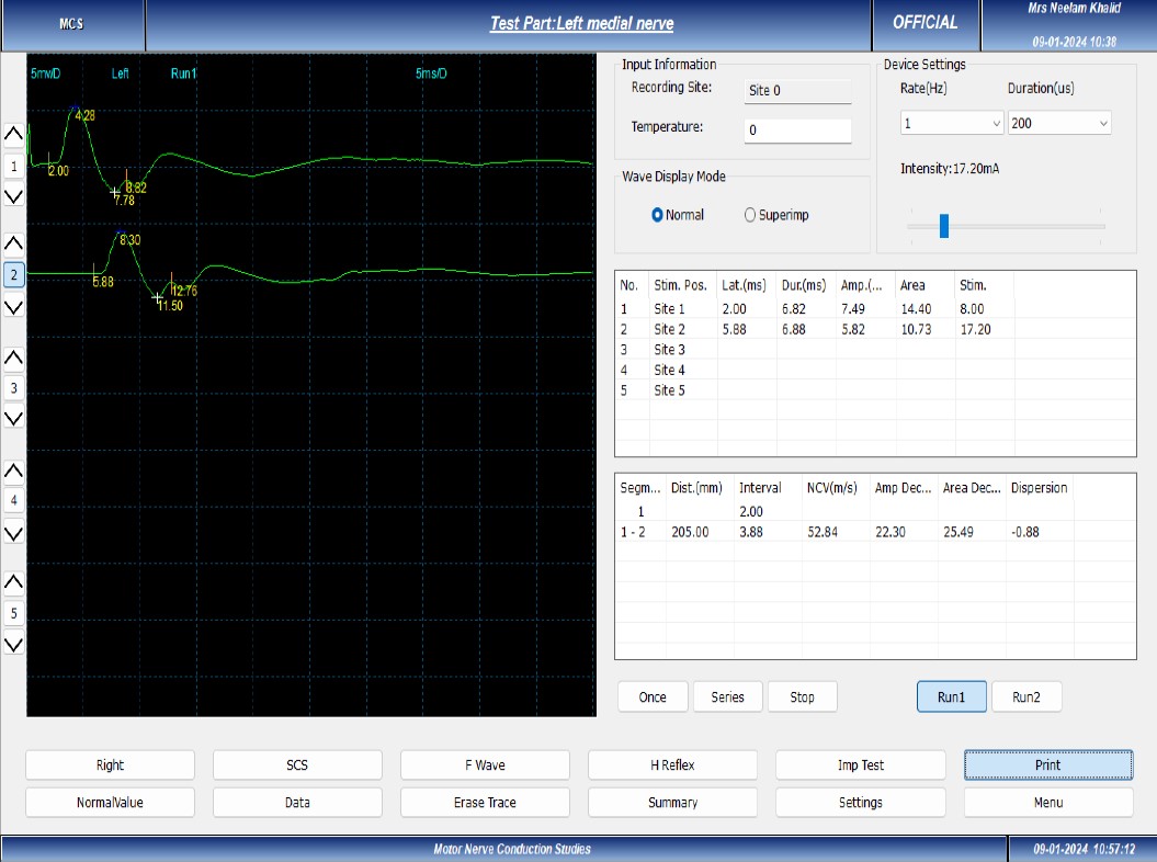 Electrodiagnostic Testing in Physical Therapy